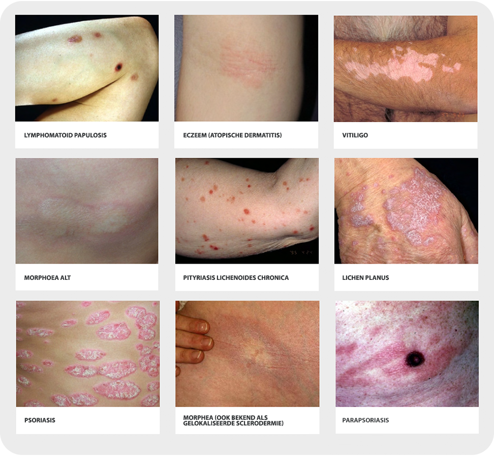Hoe wordt CTCL gediagnosticeerd? – Kyowa Kirin Hub
